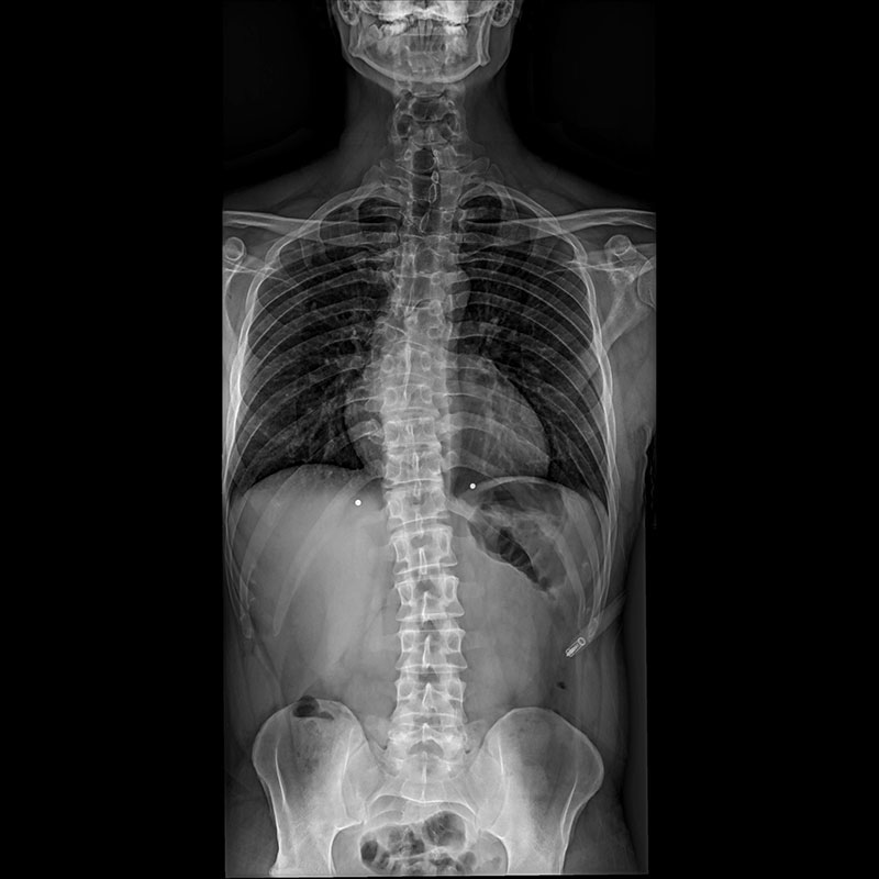 Systèmes de radiographie numérique CXDI Scoliose