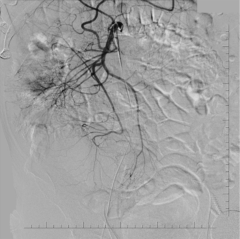 Ultimax-i Angiographie numérique avec soustraction (DSA) de l’abdomen