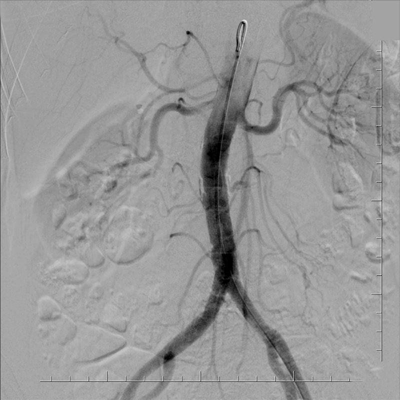 Ultimax-i Angiographie numérique avec soustraction (DSA) de l’abdomen