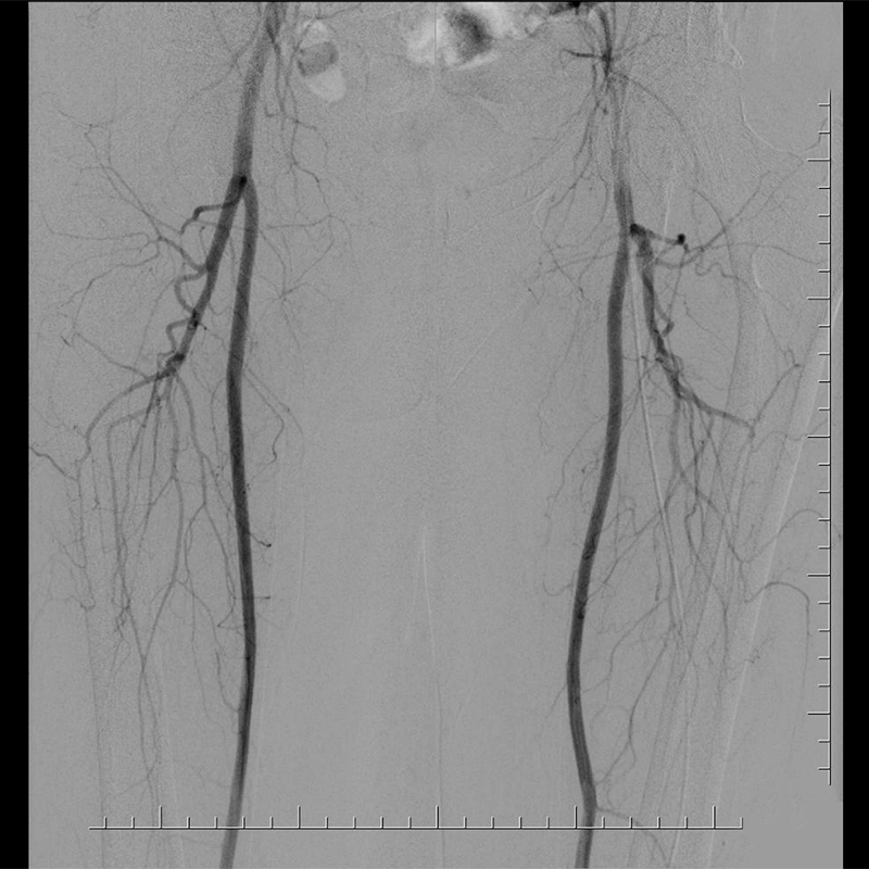 Ultimax-i Angiographie par soustraction numérique des extrémités