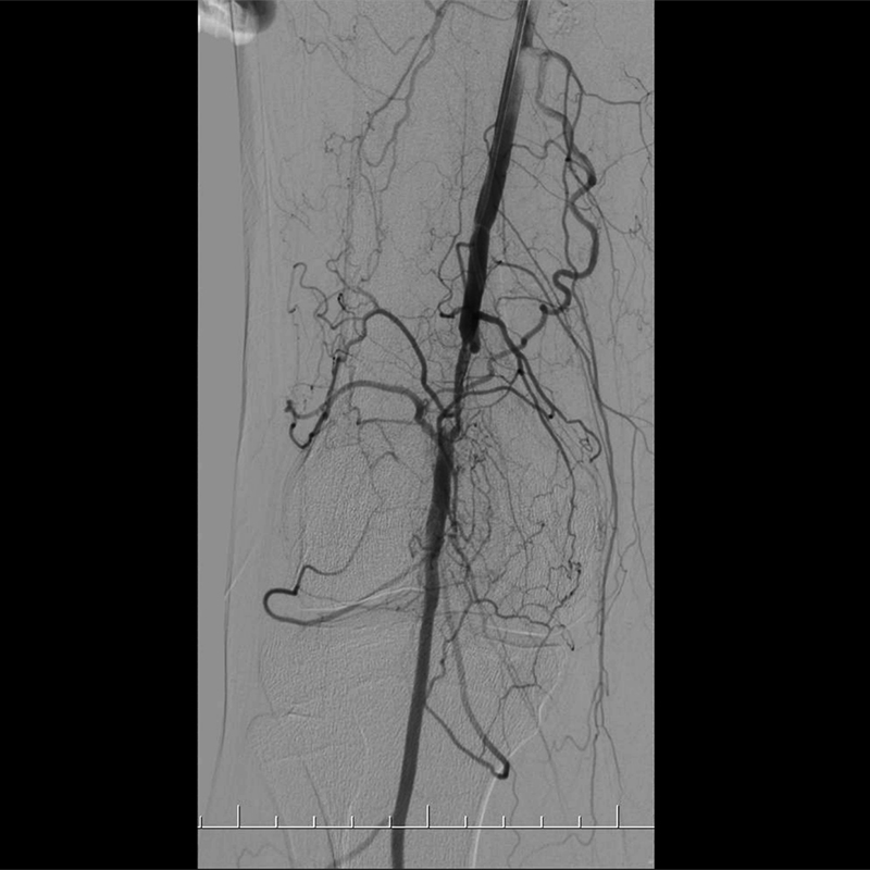 Ultimax-i Angiographie par soustraction numérique des extrémités