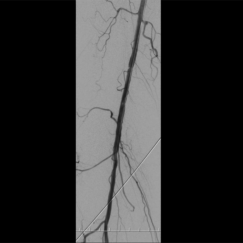 Ultimax-i Angiographie par soustraction numérique des extrémités