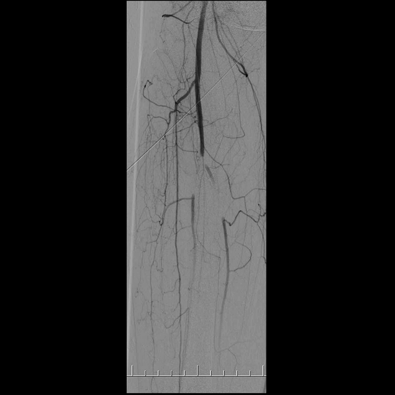 Ultimax-i Angiographie par soustraction numérique des extrémités