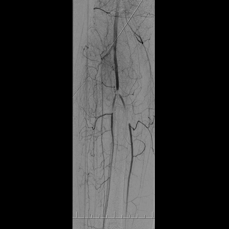 Ultimax-i Angiographie par soustraction numérique des extrémités