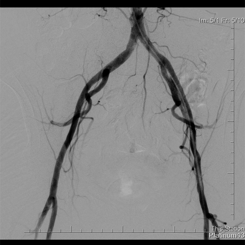 Ultimax-i Angiographie par soustraction numérique du pelvis