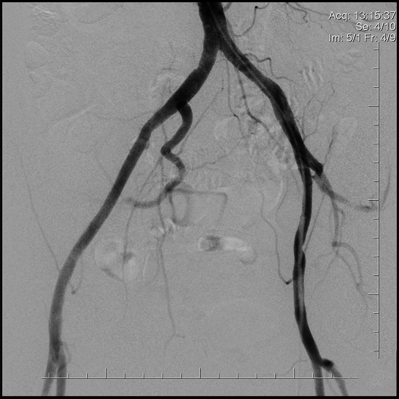 Ultimax-i Angiographie par soustraction numérique du pelvis