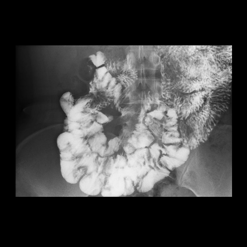 Ultimax-i Tract GI supérieur